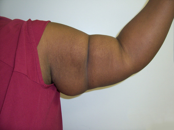 Before Arm Lift Before Arm Lift