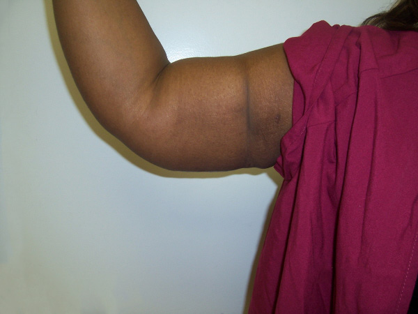 After Arm Lift After Arm Lift