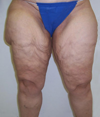 Before Thigh Lift Before Thigh Lift