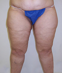 After Thigh Lift After Thigh Lift