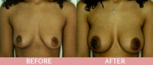 Breast Augmentation Gallery