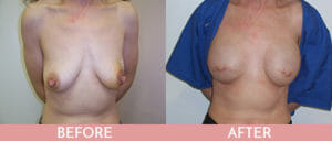 Breast Reconstruction Gallery