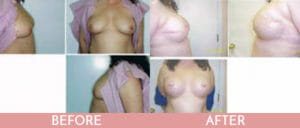 Breast Reconstruction Gallery