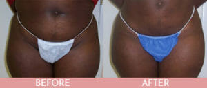 Liposuction Gallery