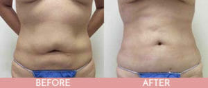 Liposuction Gallery