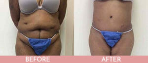 Tummy Tuck Gallery