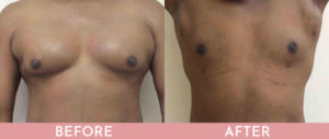 Gynecomastia Correction (Male Breast Reduction) Gallery