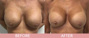 Breast Implant Exchange Gallery