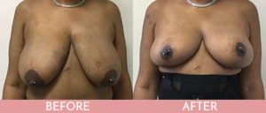 Breast Lift Gallery