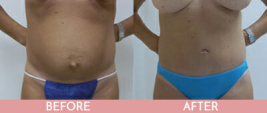 Tummy Tuck Gallery