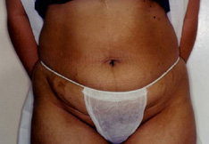 Before Liposuction