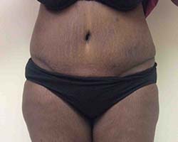 After Tummy Tuck